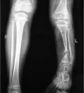 Рентгенограмма нижних конечностей в прямой проекции. Слева – здоровая нога, справа – нога с врождённым ложным суставом при нейрофиброматозе