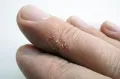 Трещины кожи на пальце руки