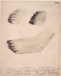 Гангрена ступней и пальцев ног ребёнка. Художник: Алджернон Стивенс