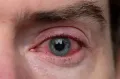 Глаз с симптомами ксерофтальмии