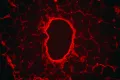 Красная флуоресцентная микрофотография липомы (доброкачественной опухоли)