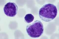 Микрофотография лимфобластов, вызывающих лимфобластный лейкоз