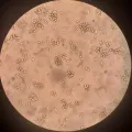 Перевиваемая суспензионная культура клеток множественной миеломы человека RPMI 8226 в поле зрения светового микроскопа