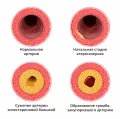 Схематическое изображение развития атеросклеротической бляшки