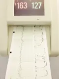 Электрокардиограмма на специальной фотографической бумаге