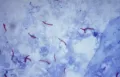 Микроскопия окрашенной по Цилю – Нильсену палочки Коха (Mycobacterium tuberculosis)