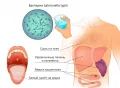Схематическое изображение возбудителя и симптомов брюшного тифа