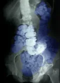 Рентгенограмма органов брюшной полости в прямой проекции, показывающая запор, вызванный пероральным приёмом сульфата бария