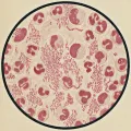 Мазок крови человека, больного дифтерией, с видимыми бактериями Corynebacterium diphtheriae среди клеток крови