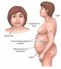 Схематическое изображение клинических проявлений болезни Иценко – Кушинга