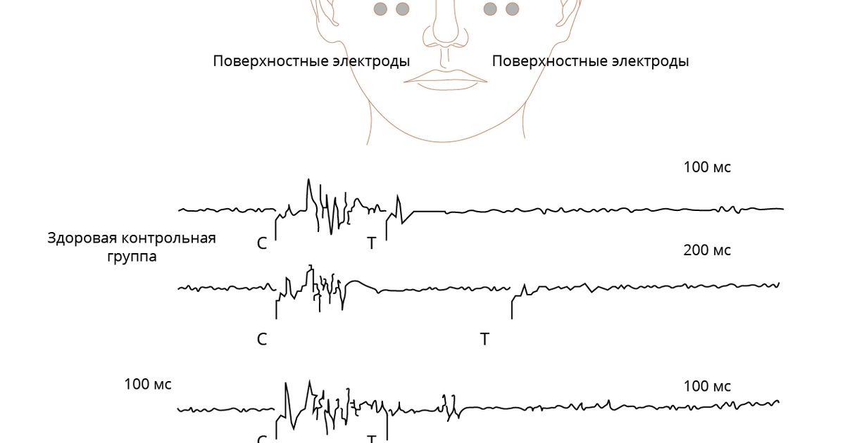 Блефароспазм. Большая российская энциклопедия