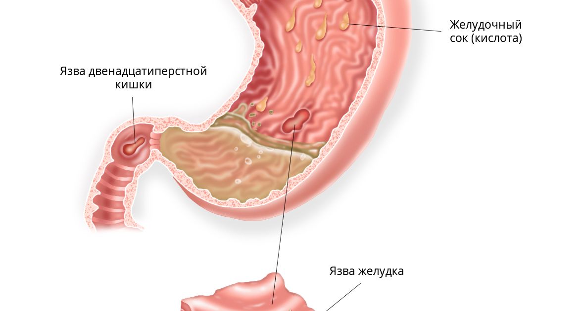 Стул при язве двенадцатиперстной кишки